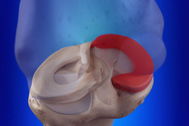 Dor no menisco: preciso de cirurgia? Posso voltar a correr?