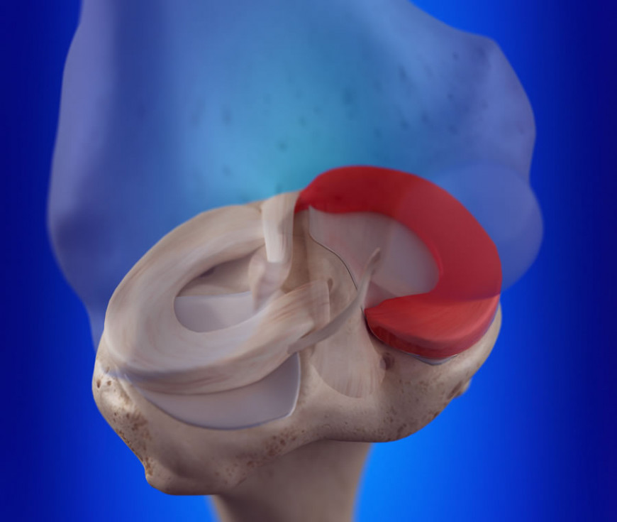Dor no menisco: preciso de cirurgia? Posso voltar a correr?